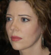 Rhinoplasty case #12856