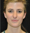Rhinoplasty case #12863