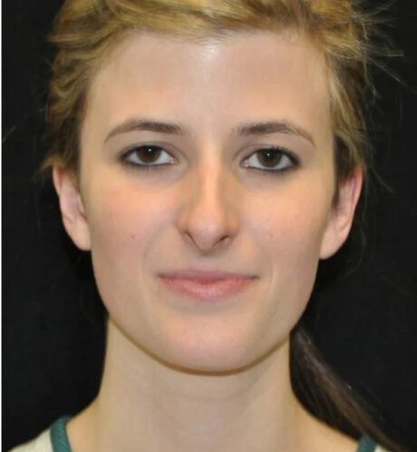 Rhinoplasty case #12863
