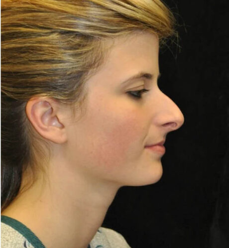 Rhinoplasty case #12863