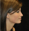 Rhinoplasty case #12863
