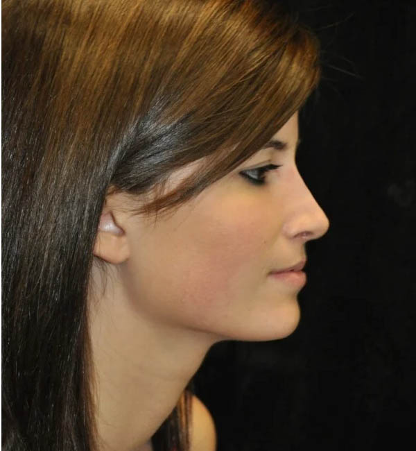 Rhinoplasty case #12863