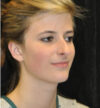 Rhinoplasty case #12863