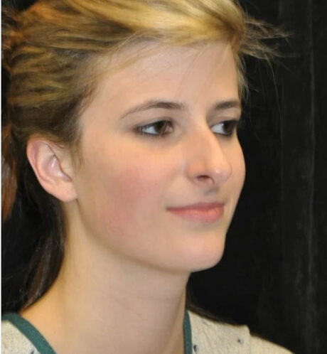 Rhinoplasty case #12863