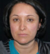 Rhinoplasty case #12871