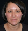 Rhinoplasty case #12871