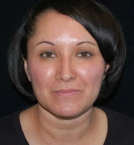 Rhinoplasty case #12871