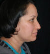Rhinoplasty case #12871