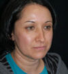 Rhinoplasty case #12871