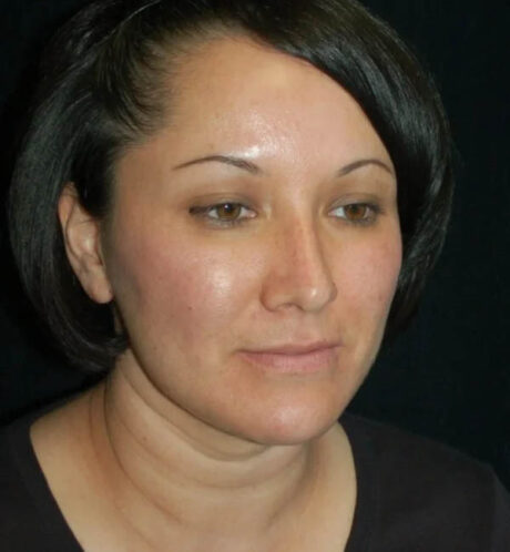 Rhinoplasty case #12871