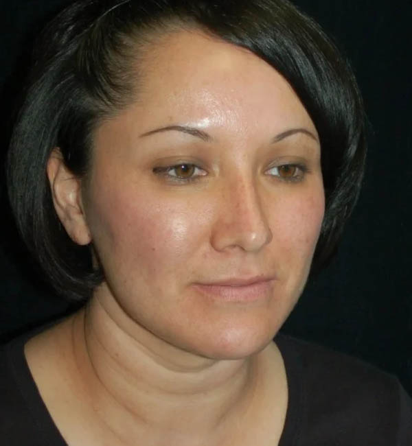 Rhinoplasty case #12871