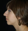 Rhinoplasty case #12878