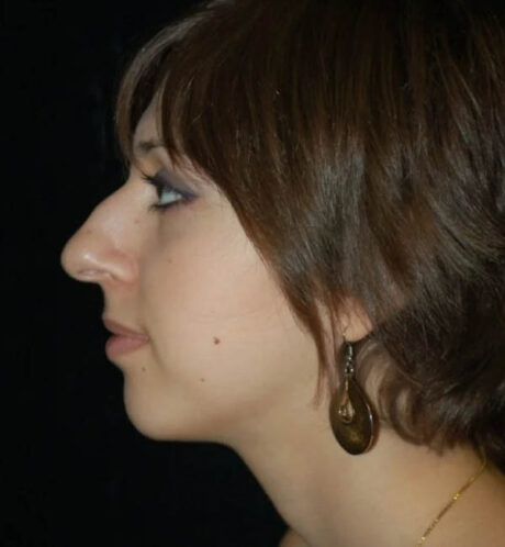 Rhinoplasty case #12878