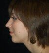 Rhinoplasty case #12878