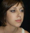 Rhinoplasty case #12878