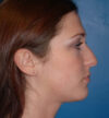 Rhinoplasty case #12884