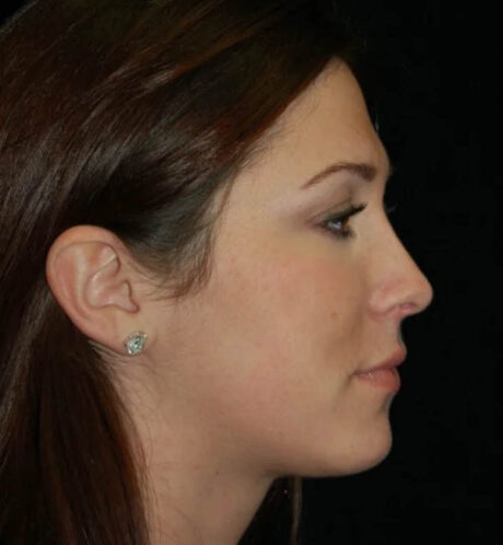 Rhinoplasty case #12884