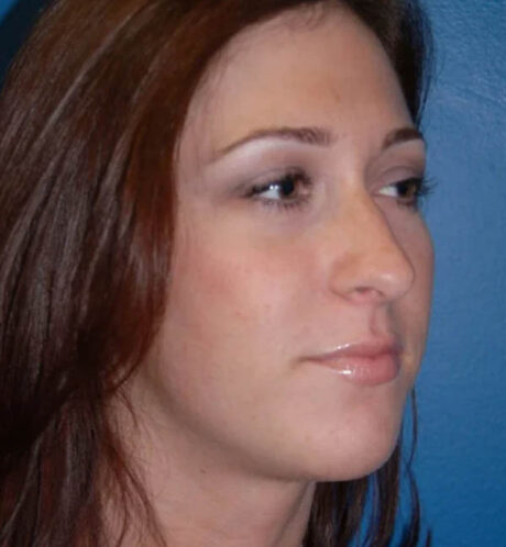 Rhinoplasty case #12884