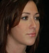 Rhinoplasty case #12884