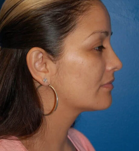 Rhinoplasty case #12889