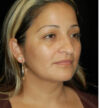 Rhinoplasty case #12889