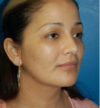 Rhinoplasty case #12889