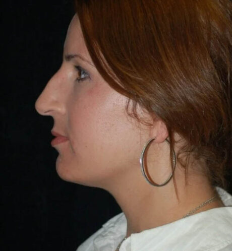 Rhinoplasty case #12895