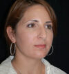 Rhinoplasty case #12895