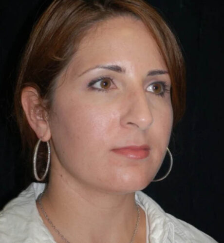 Rhinoplasty case #12895