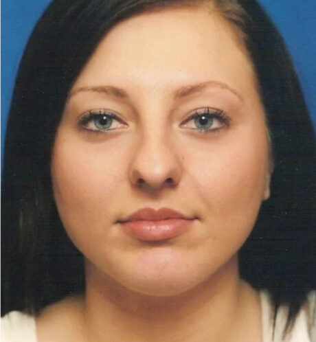 Rhinoplasty case #12902