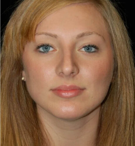Rhinoplasty case #12902