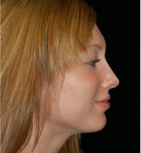 Rhinoplasty case #12902