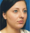 Rhinoplasty case #12902