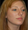 Rhinoplasty case #12902