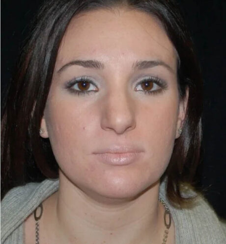 Rhinoplasty case #12910