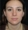 Rhinoplasty case #12910