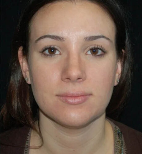 Rhinoplasty case #12910