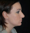 Rhinoplasty case #12910