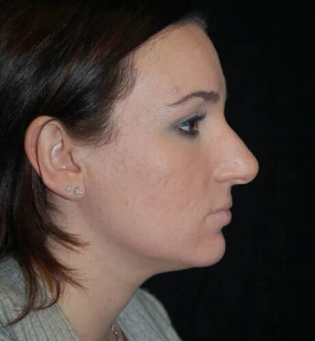 Rhinoplasty case #12910