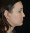 Rhinoplasty case #12910