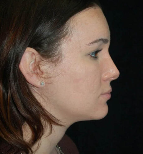 Rhinoplasty case #12910