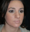 Rhinoplasty case #12910