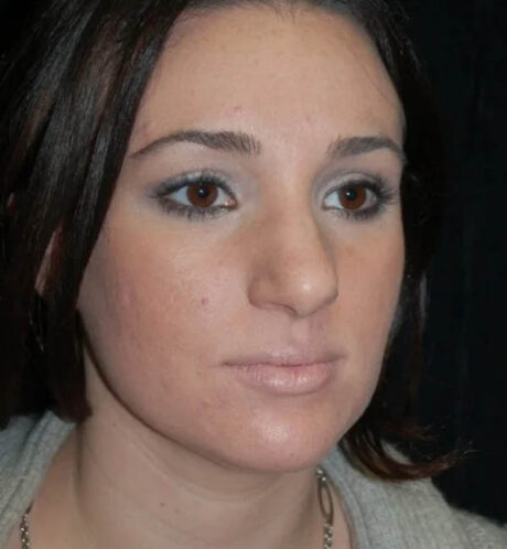 Rhinoplasty case #12910