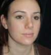 Rhinoplasty case #12910