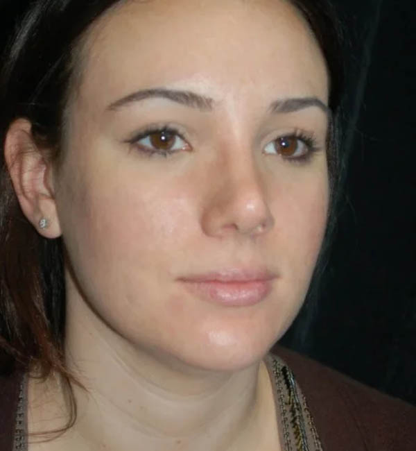 Rhinoplasty case #12910