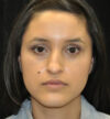 Rhinoplasty case #12917