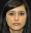 Rhinoplasty case #12917
