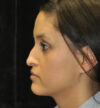 Rhinoplasty case #12917