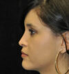 Rhinoplasty case #12917