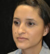 Rhinoplasty case #12917